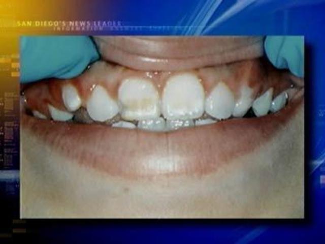 Oral